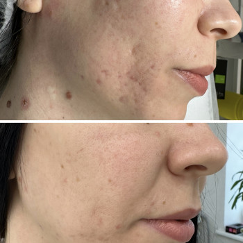 Мікроголковій RF ліфтинг Morpheus 8
                    Врач-косметолог Юлия Киев