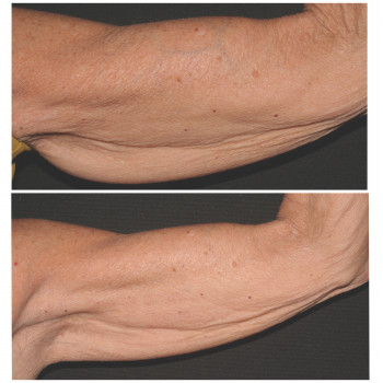 Мікроголковій RF ліфтинг Morpheus 8
                    Врач-косметолог Юлия Киев