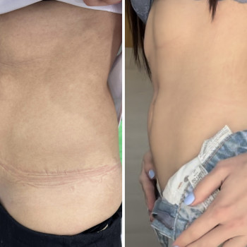 Ultraformer MPT
                    Лікар-косметолог Юлия Київ