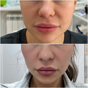 Ultraformer MPT
                    Лікар-косметолог Юлия Київ