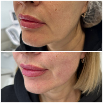 Ultraformer MPT
                    Лікар-косметолог Юлия Київ