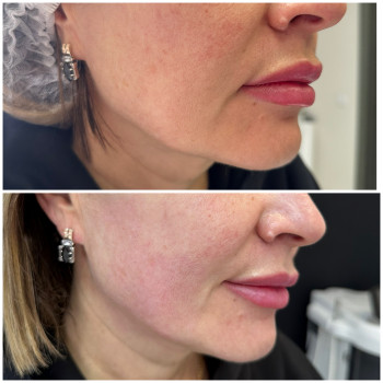 Ultraformer MPT
                    Лікар-косметолог Юлия Київ