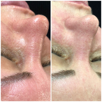 Чистки та пілінги
                    Косметологический центр Dr. Galatska clinic Киев