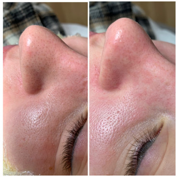 Чистки та пілінги
                    Косметологический центр Dr. Galatska clinic Киев