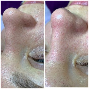 Чистки та пілінги
                    Косметологический центр Dr. Galatska clinic Киев