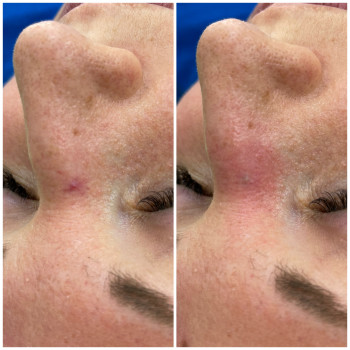 Lumecca IPL лікування пігментації, акне
                    Косметологічний центр Dr. Galatska clinic Київ