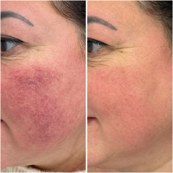 Lumecca IPL лікування пігментації, акне
                    Косметологічний центр Dr. Galatska clinic Київ