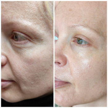 До та після масажу та логлядових процедур