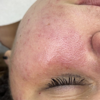 Чистка обличчя
                    Лікар-косметолог Ирина Краматорськ