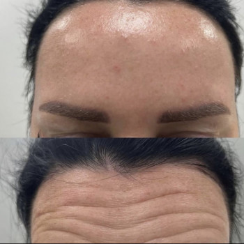 Ботокс
                    Врач-косметолог Ирина Краматорск