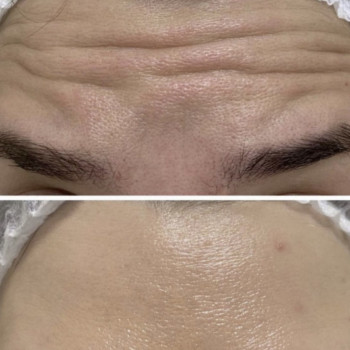 Ботокс
                    Врач-косметолог Ирина Краматорск