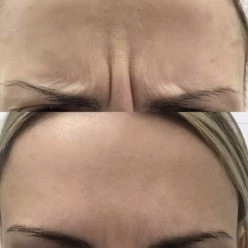 Ботокс
                    Врач-косметолог Ирина Краматорск