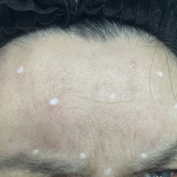 Ботокс
                    Врач-косметолог Ирина Краматорск