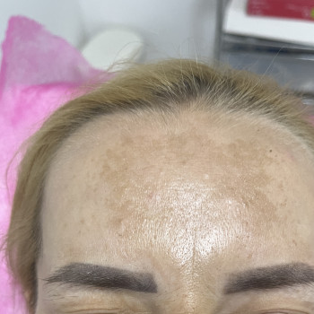 Ботокс
                    Врач-косметолог Ирина Краматорск