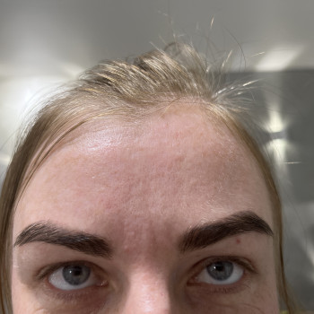 Ботокс
                    Врач-косметолог Ирина Краматорск