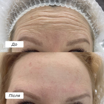 Результат до процедури та через 14 днів після проведення процедури