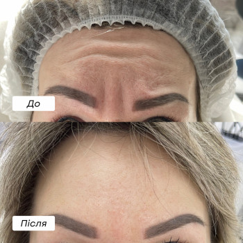 Ботулінотерапія
                    Косметолог Лілія Ровно
