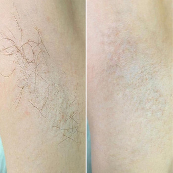 Ось що буде після 15 сеансів депіляції ;)     