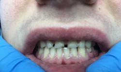 Вініри та коронки Стоматологічна клініка Nazaria Dental Черкаси