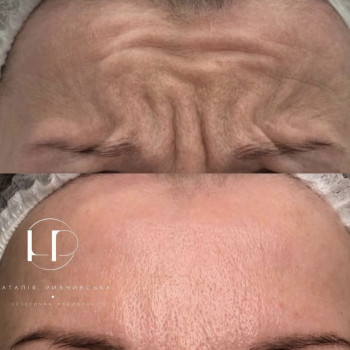 Ботулотоксин
                    Врач-косметолог Наталия Киев