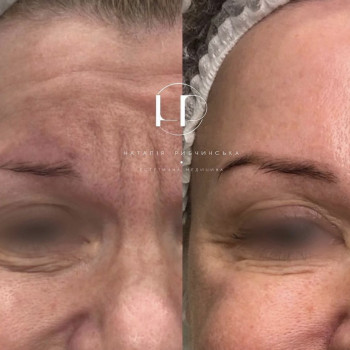 Ботулотоксин
                    Врач-косметолог Наталия Киев