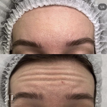 Ботулотоксин
                    Врач-косметолог Наталия Киев