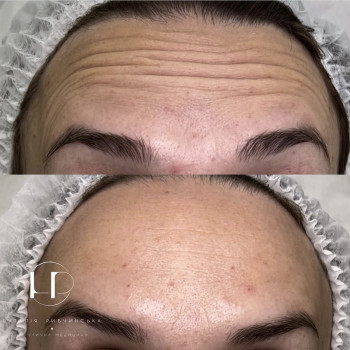 Ботулотоксин
                    Врач-косметолог Наталия Киев