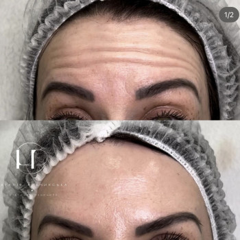 Ботулотоксин
                    Врач-косметолог Наталия Киев