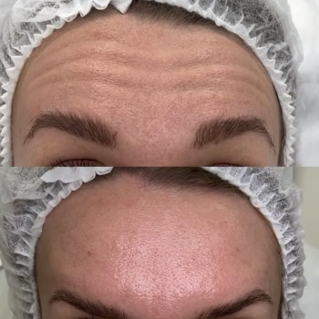 Ботулотоксин
                    Врач-косметолог Наталия Киев