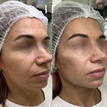 PDRN полінуклеотиди
                    Врач-косметолог Наталия Киев