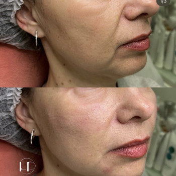 PDRN полінуклеотиди
                    Врач-косметолог Наталия Киев