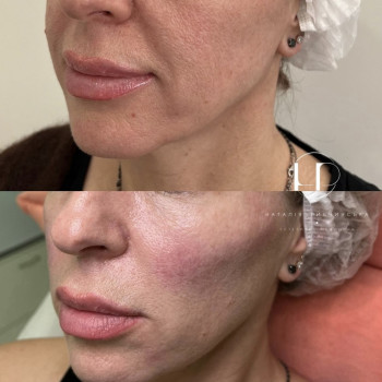 PDRN полінуклеотиди
                    Врач-косметолог Наталия Киев