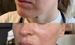 Мезонитки Лікар-косметолог Наталия Київ