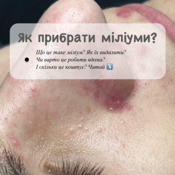 «До»чистки і видалення міліумів! Чистка обличчя підлітку.