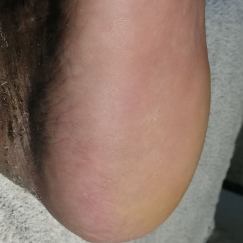   на пятках,  - ПОСЛЕ 2