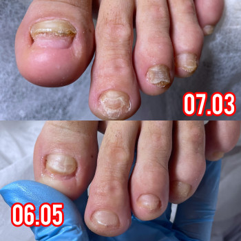 Оніхомікоз динаміка