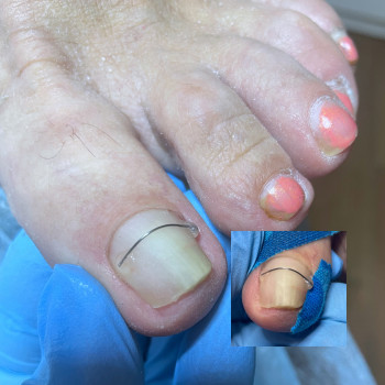 Титанова нитка