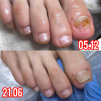 Оніхомікоз динаміка