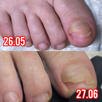 Оніхомікоз динаміка