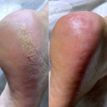 Обробка тріщин