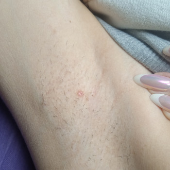 После 3х процедур