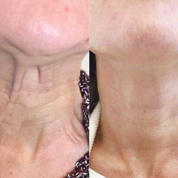 Омолодження шиї комплекс процедур