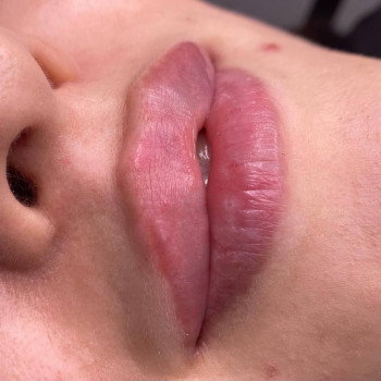 Губи після контурної пластики