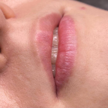 Губи до контурної пластики