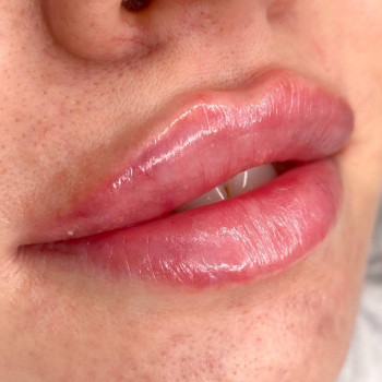 Губи після контурної пластики