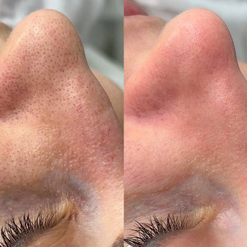 Чиста шкіра