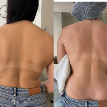 Масаж спини і як бонус чудовий лімфодренаж