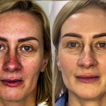 Проведено 4 процедури, фото - косметологічний центр Cosmetology & Aesthetic "Oksana Pyshnova"