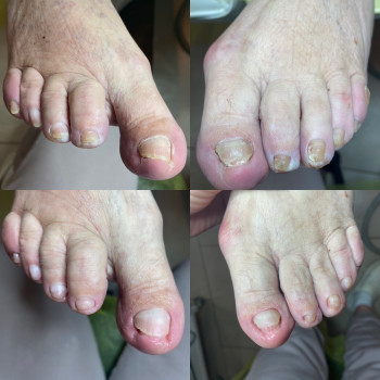 Оніхомікоз