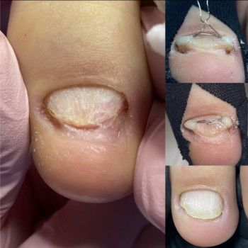 Деформовані нігті